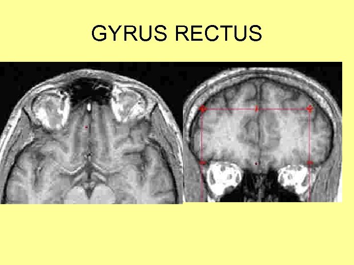 GYRUS RECTUS 
