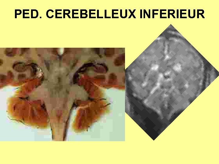 PED. CEREBELLEUX INFERIEUR 