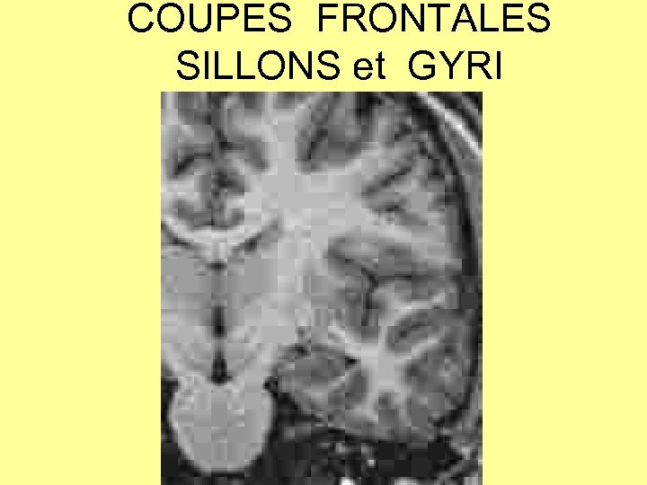 COUPES FRONTALES SILLONS et GYRI 