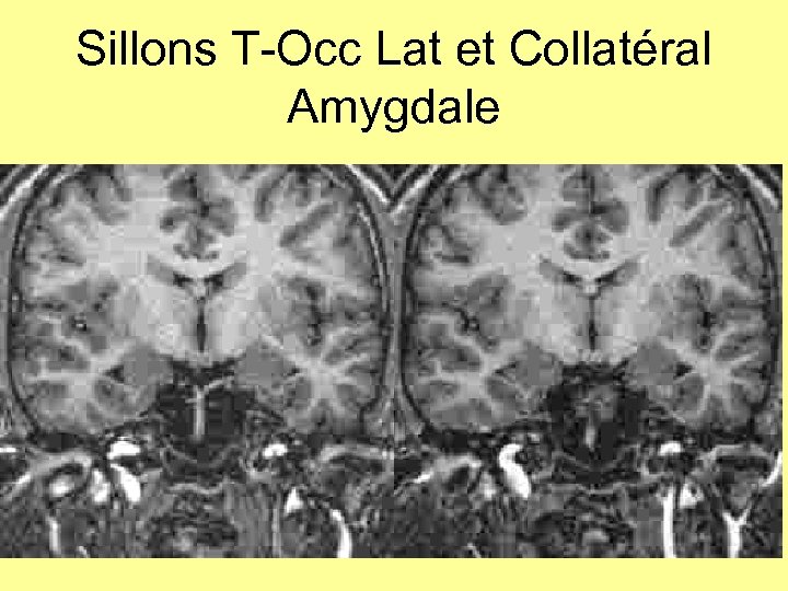 Sillons T-Occ Lat et Collatéral Amygdale 