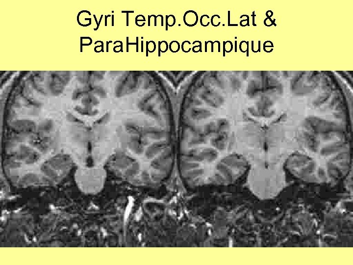 Gyri Temp. Occ. Lat & Para. Hippocampique 