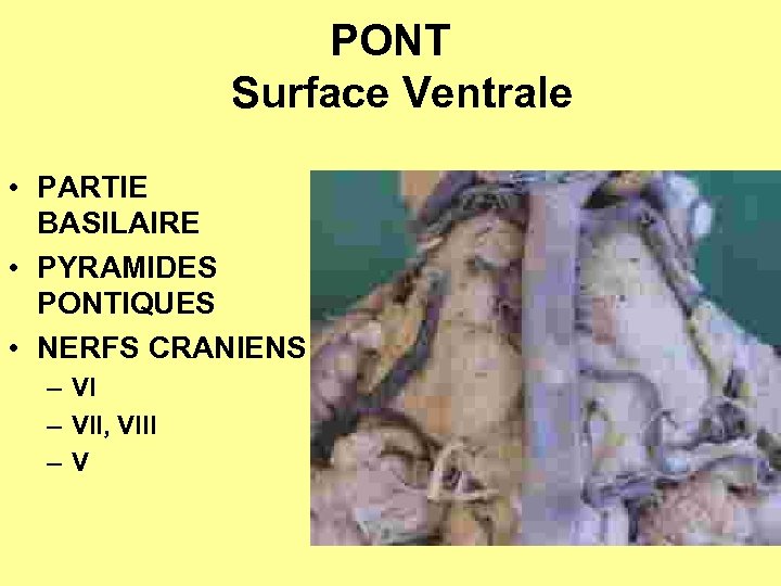 PONT Surface Ventrale • PARTIE BASILAIRE • PYRAMIDES PONTIQUES • NERFS CRANIENS – VII,