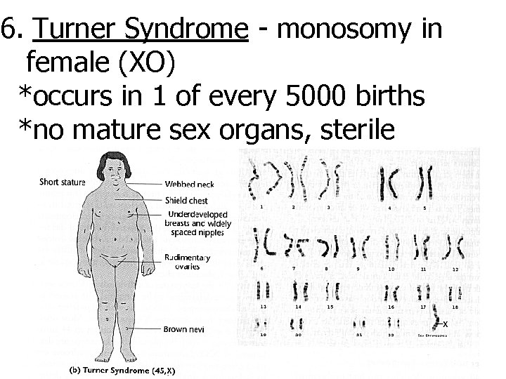 6. Turner Syndrome - monosomy in female (XO) *occurs in 1 of every 5000 bir...