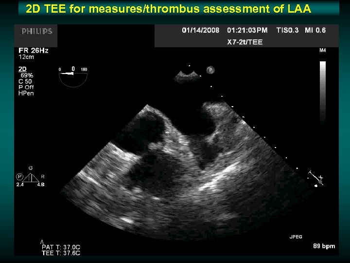 2 D TEE for measures/thrombus assessment of LAA 