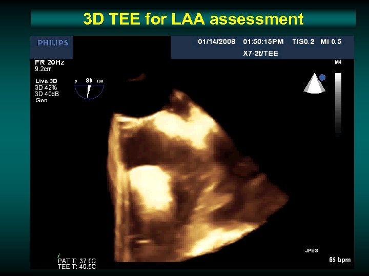 3 D TEE for LAA assessment 