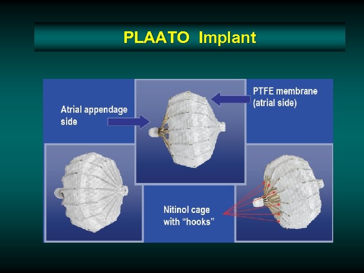 PLAATO Implant 