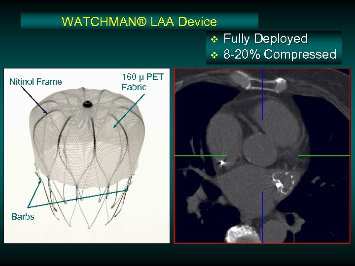WATCHMAN® LAA Device v v Nitinol Frame Barbs 160 µ PET Fabric Fully Deployed