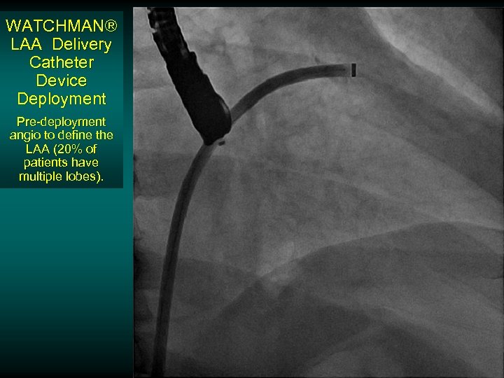 WATCHMAN® LAA Delivery Catheter Device Deployment Pre-deployment angio to define the LAA (20% of