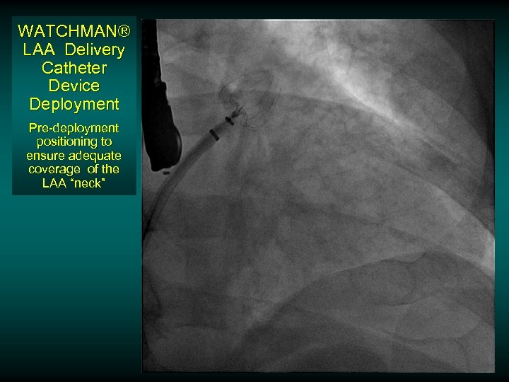 WATCHMAN® LAA Delivery Catheter Device Deployment Pre-deployment positioning to ensure adequate coverage of the