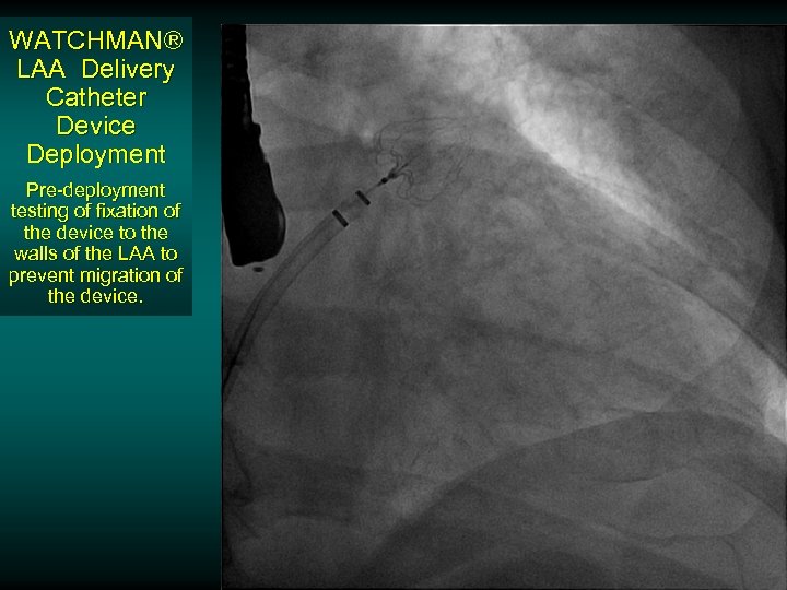 WATCHMAN® LAA Delivery Catheter Device Deployment Pre-deployment testing of fixation of the device to
