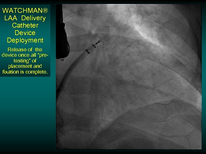 WATCHMAN® LAA Delivery Catheter Device Deployment Release of the device once all “pretesting” of