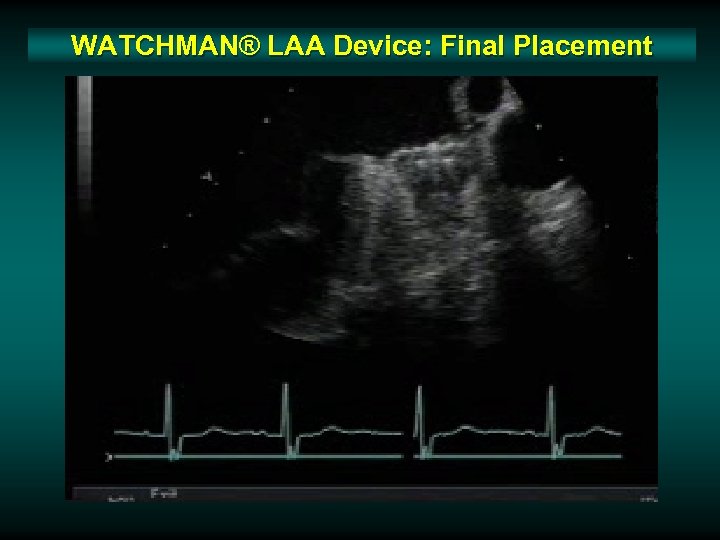 WATCHMAN® LAA Device: Final Placement 