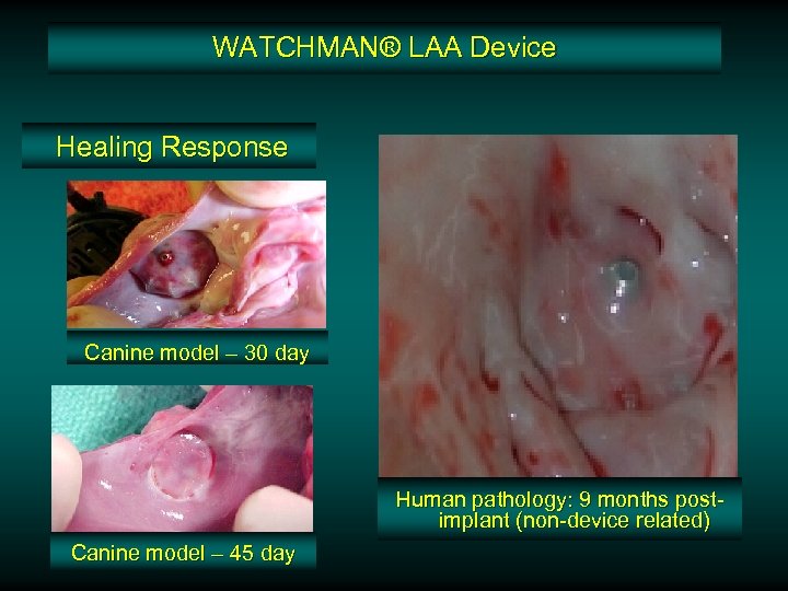 WATCHMAN® LAA Device Healing Response Canine model – 30 day Human pathology: 9 months