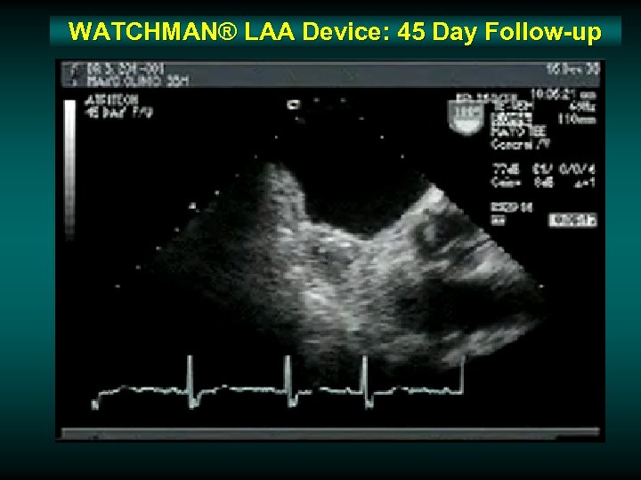 WATCHMAN® LAA Device: 45 Day Follow-up 