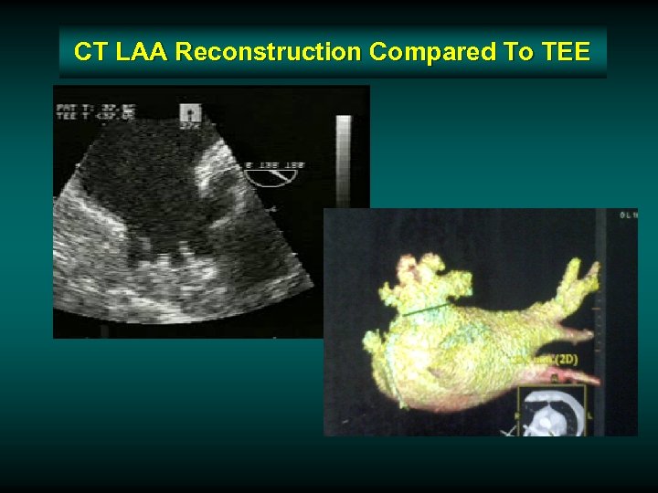 CT LAA Reconstruction Compared To TEE 