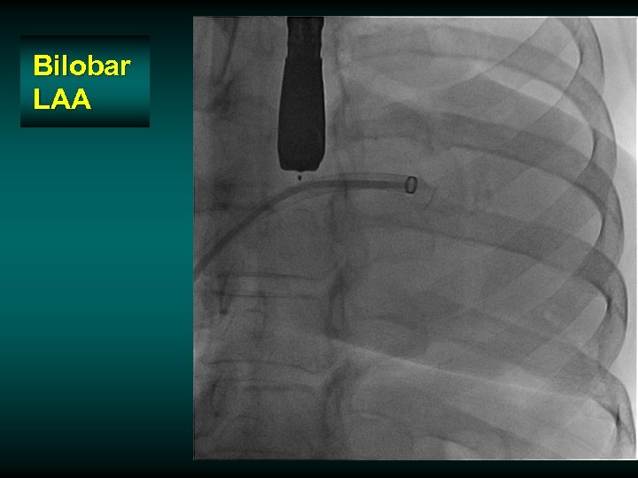 Bilobar LAA 