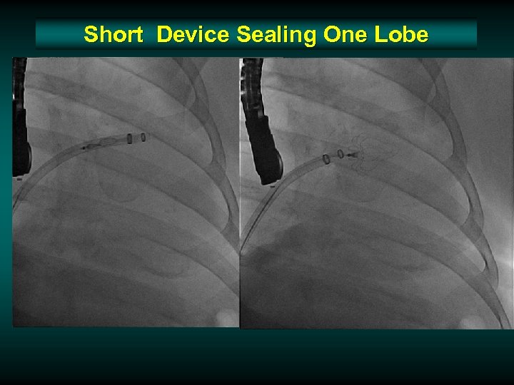 Short Device Sealing One Lobe 