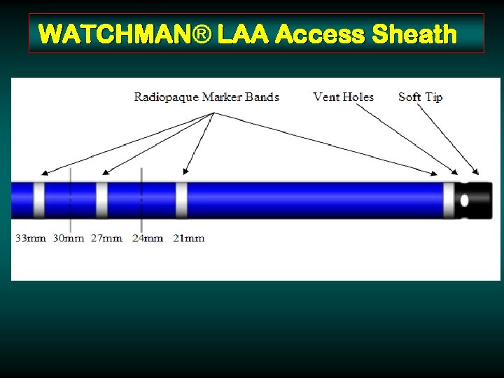 WATCHMAN® LAA Access Sheath 14 F Double Curve 14 F Single Curve 