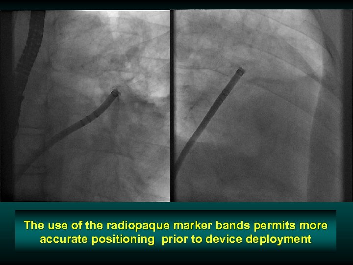 The use of the radiopaque marker bands permits more accurate positioning prior to device