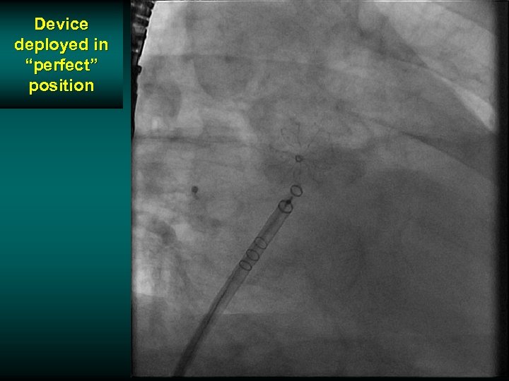 Device deployed in “perfect” position 