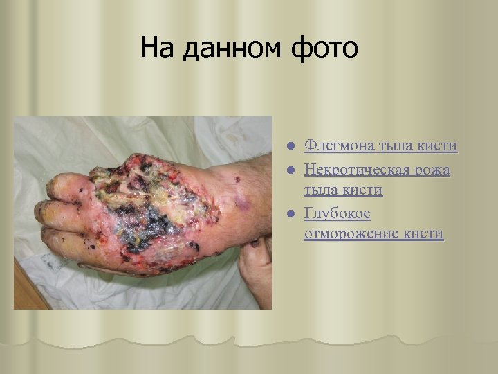 На данном фото l l l Флегмона тыла кисти Некротическая рожа тыла кисти Глубокое