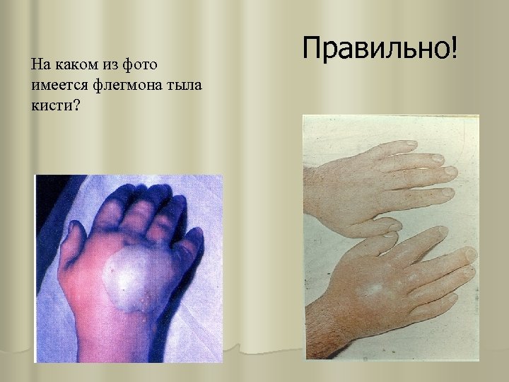 На каком из фото имеется флегмона тыла кисти? Правильно! 