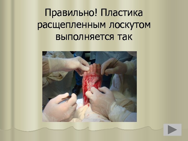 Правильно! Пластика расщепленным лоскутом выполняется так 