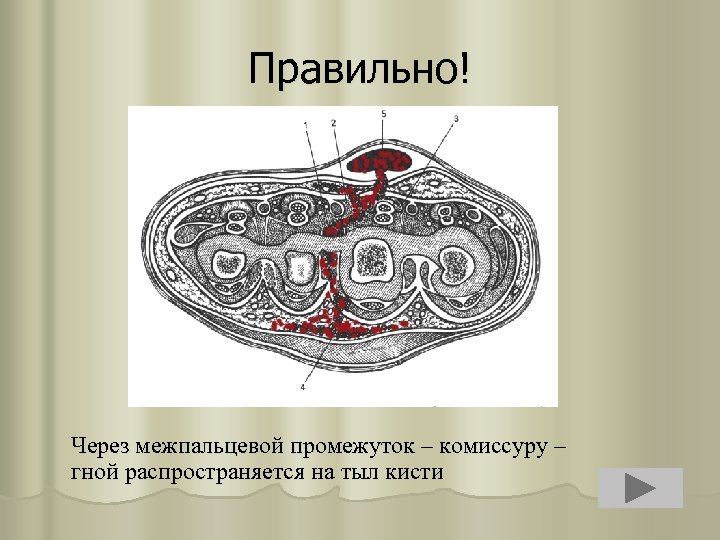 Правильно! Через межпальцевой промежуток – комиссуру – гной распространяется на тыл кисти 