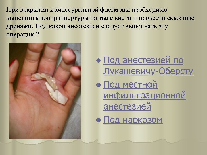 При вскрытии комиссуральной флегмоны необходимо выполнить контраппертуры на тыле кисти и провести сквозные дренажи.