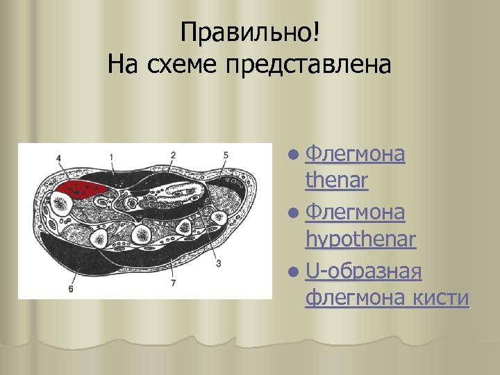 Правильно! На схеме представлена l Флегмона thenar l Флегмона hypothenar l U-образная флегмона кисти