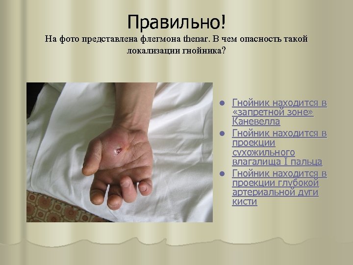 Правильно! На фото представлена флегмона thenar. В чем опасность такой локализации гнойника? Гнойник находится