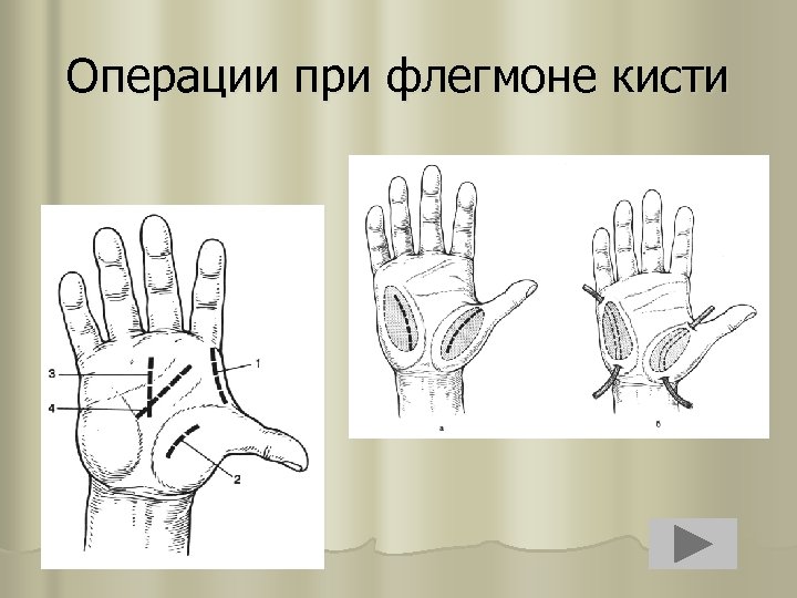 Операции при флегмоне кисти 
