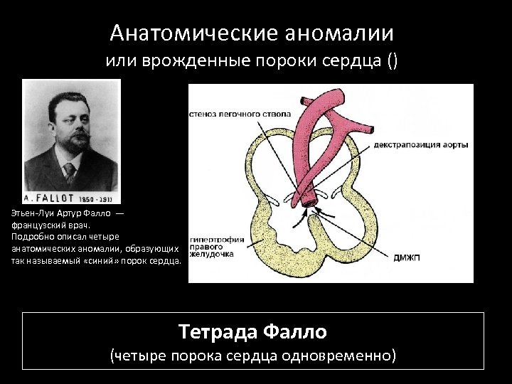 Анатомические аномалии или врожденные пороки сердца () Этьен-Луи Артур Фалло — французский врач. Подробно