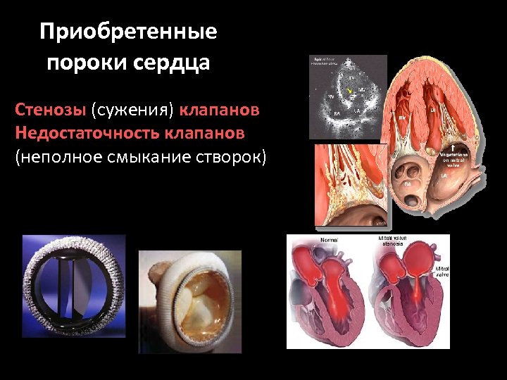 Приобретенные пороки сердца Стенозы (сужения) клапанов Недостаточность клапанов (неполное смыкание створок) 