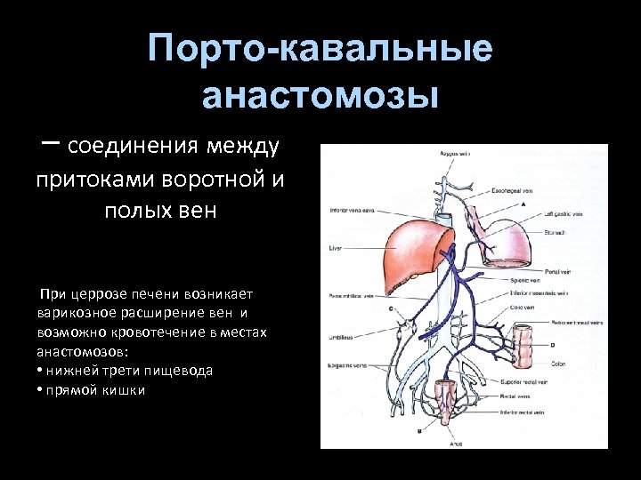 Порто-кавальные анастомозы – соединения между притоками воротной и полых вен При церрозе печени возникает