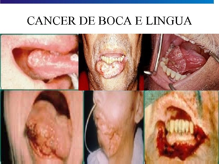 CANCER DE BOCA E LINGUA 