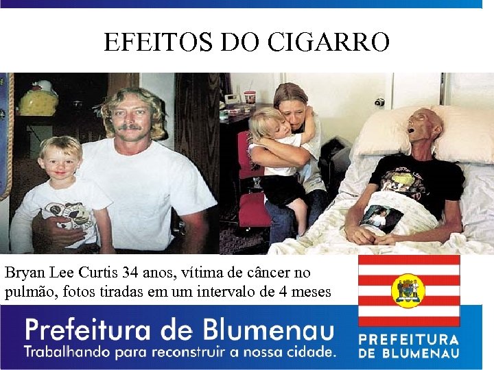 EFEITOS DO CIGARRO Bryan Lee Curtis 34 anos, vítima de câncer no pulmão, fotos