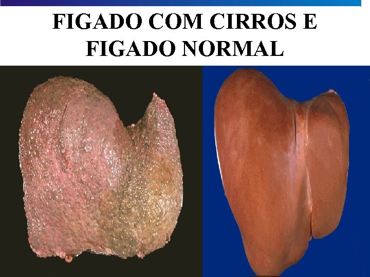 FIGADO COM CIRROS E FIGADO NORMAL 
