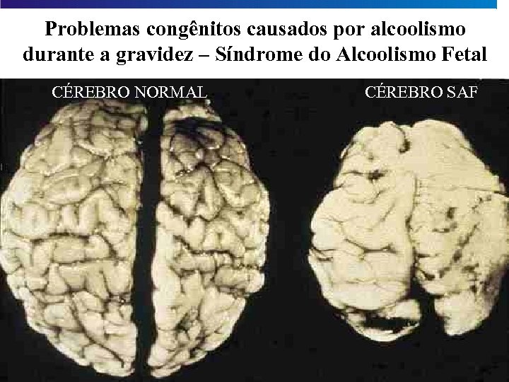 Problemas congênitos causados por alcoolismo durante a gravidez – Síndrome do Alcoolismo Fetal CÉREBRO