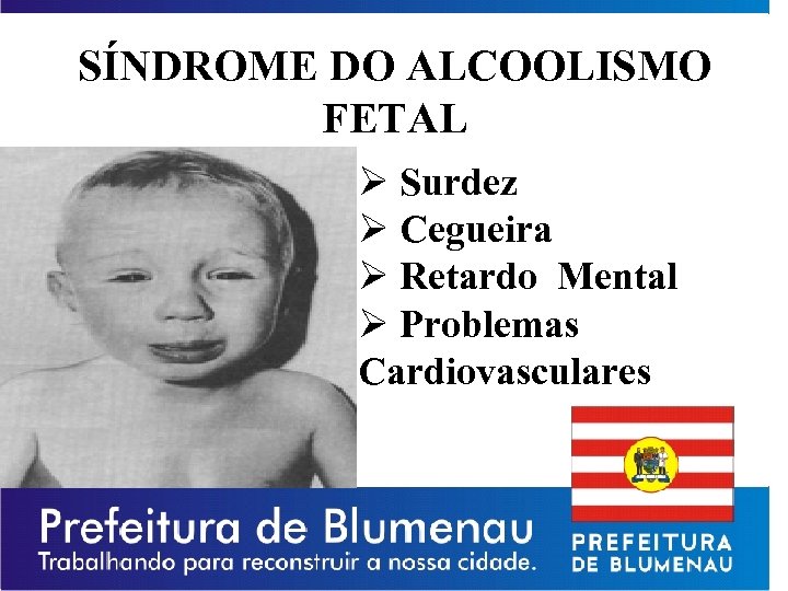 SÍNDROME DO ALCOOLISMO FETAL Ø Surdez Ø Cegueira Ø Retardo Mental Ø Problemas Cardiovasculares