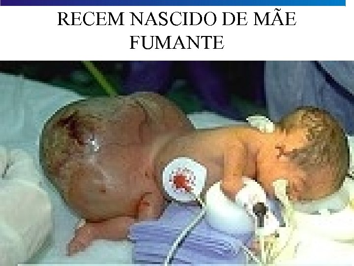 RECEM NASCIDO DE MÃE FUMANTE 