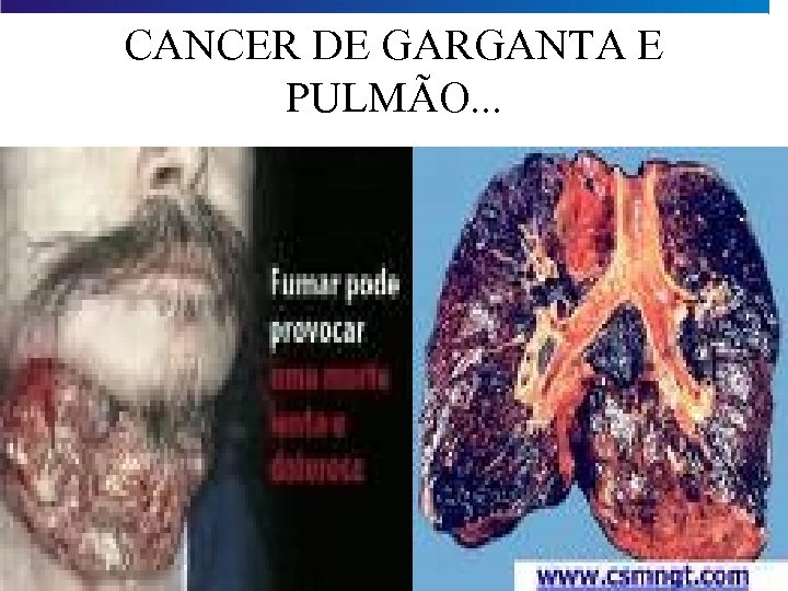 CANCER DE GARGANTA E PULMÃO. . . 