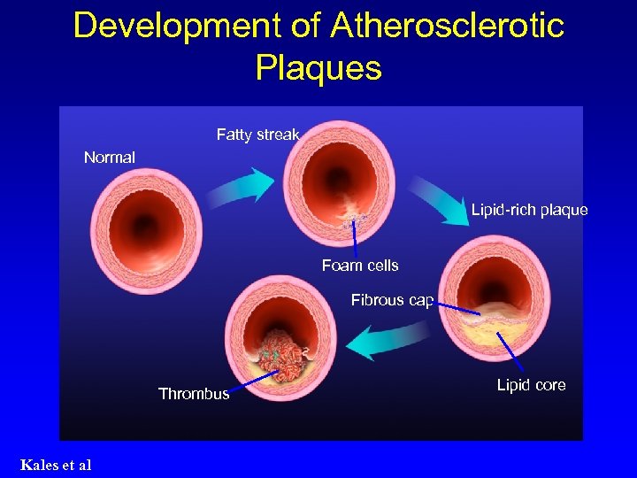 Development of Atherosclerotic Plaques Fatty streak Normal Lipid-rich plaque Foam cells Fibrous cap Thrombus