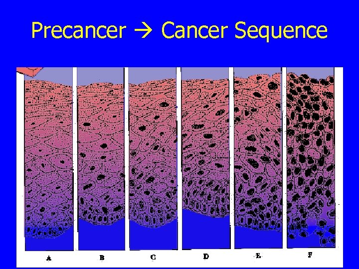 Precancer Cancer Sequence 