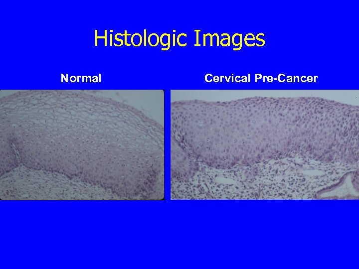 Histologic Images Normal Cervical Pre-Cancer 