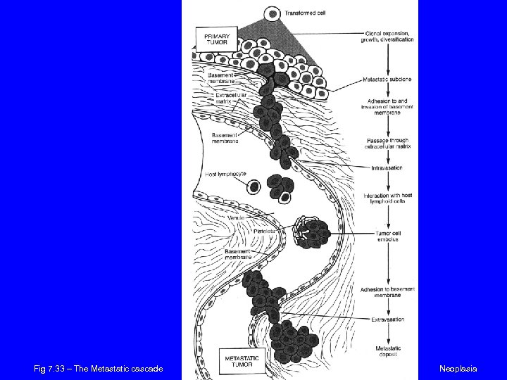 Fig 7. 33 – The Metastatic cascade Neoplasia 
