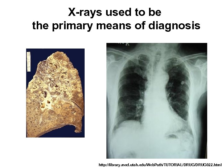 X-rays used to be the primary means of diagnosis http: //library. med. utah. edu/Web.