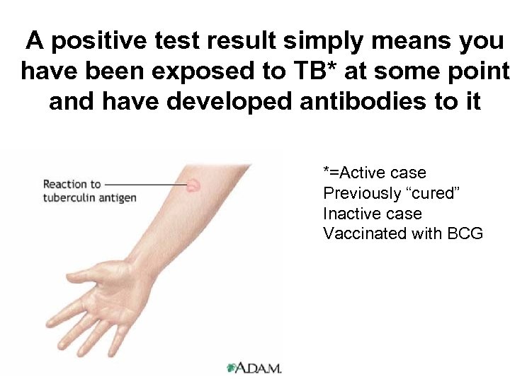 A positive test result simply means you have been exposed to TB* at some