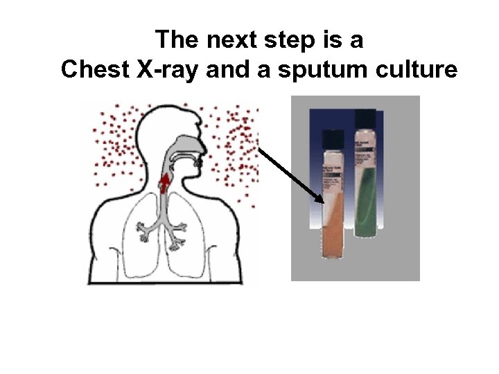 The next step is a Chest X-ray and a sputum culture 