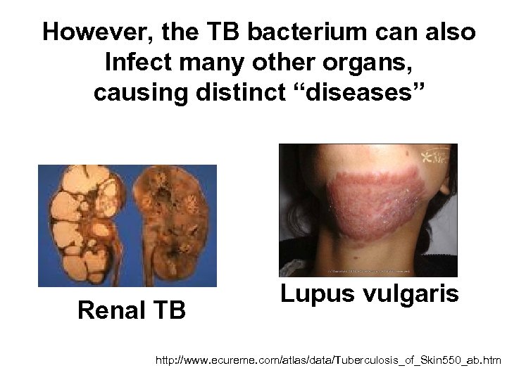 However, the TB bacterium can also Infect many other organs, causing distinct “diseases” Renal